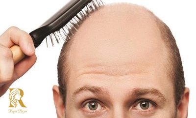 تفاوت قرص ریزش مو بانوان و آقایان