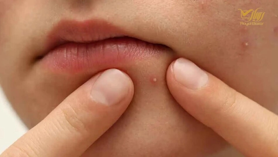 استفاده از کرم ضد جوش تاریخ‌گذشته یا نگهداری نادرست محصول