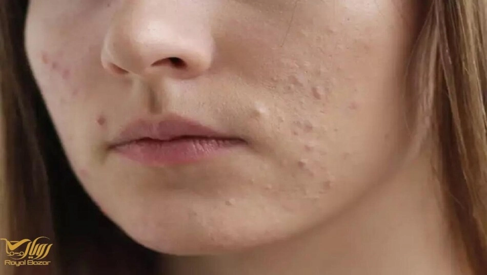 بر اساس نوع پوست، بهترین کرم ضد جوش برای جوش‌های زیرپوستی را چطور انتخاب کنیم؟