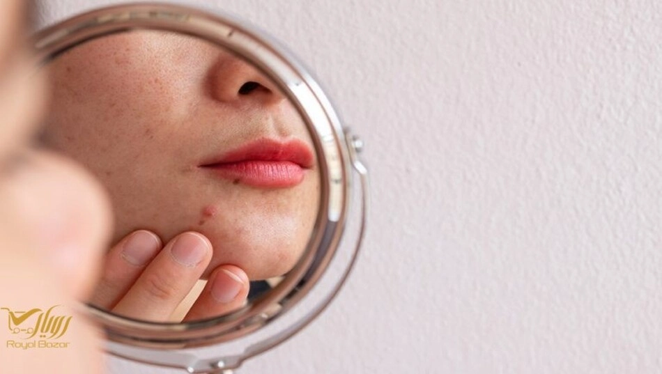 کرم ضد جوش برای جوش‌ زیرپوستی