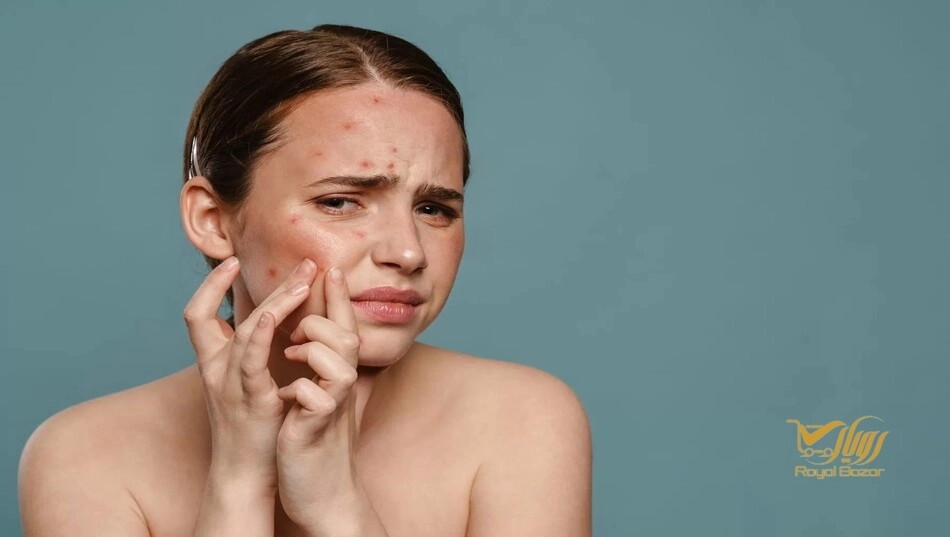 کرم ضد جوش برای پوست حساس