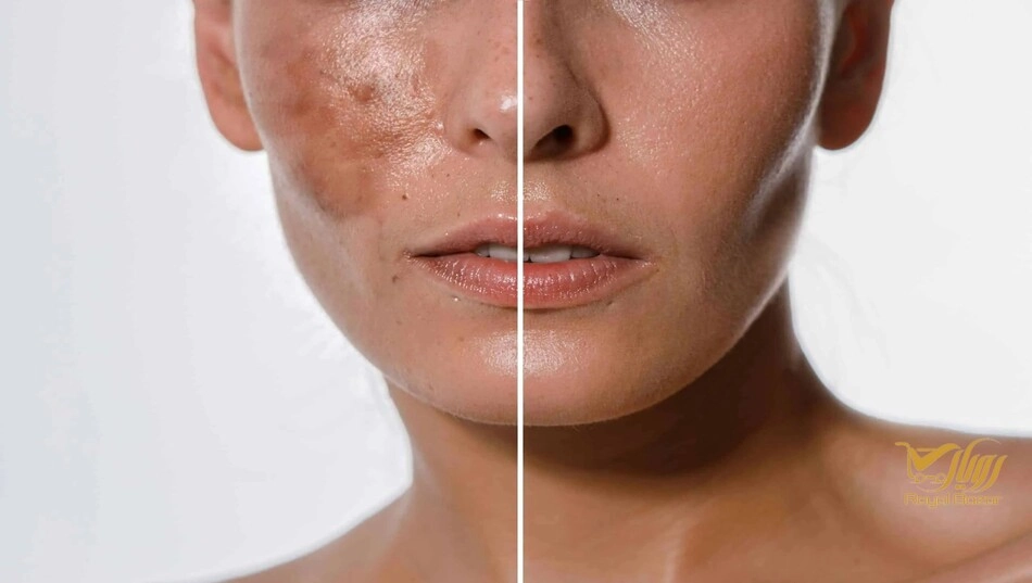 بهترین کرم ضد لک برای جای جوش چه ویژگی‌هایی باید داشته باشد؟