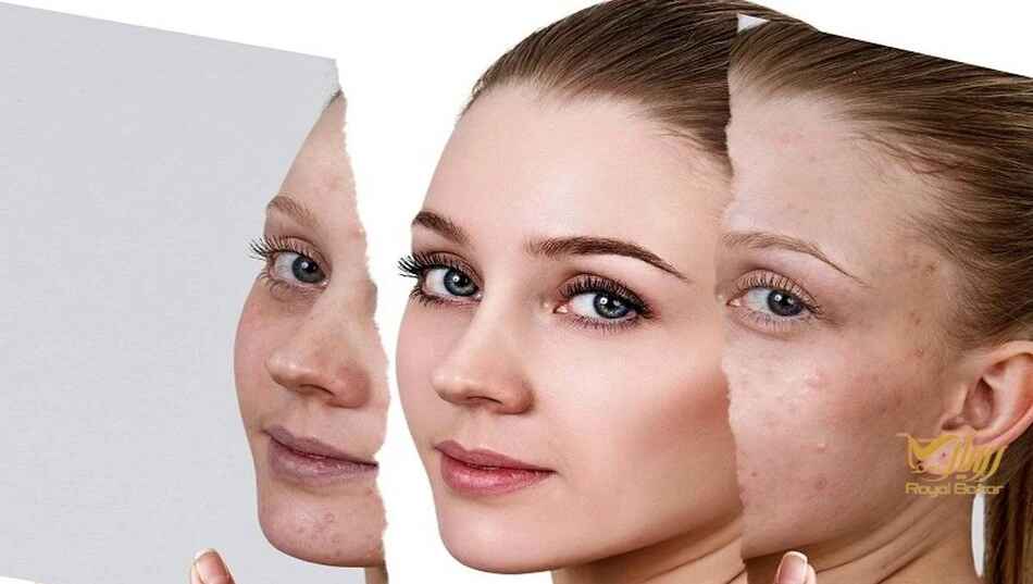 بهترین کرم ضد لک برای جای جوش؛ انتخاب بر اساس نوع لک