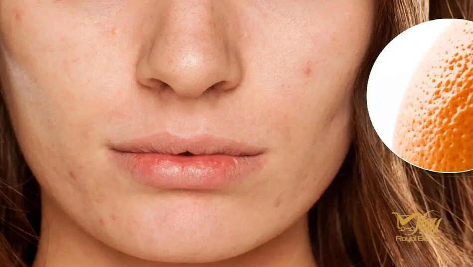 ترکیبات ایمن کرم ضد جوش برای پوست های حساس