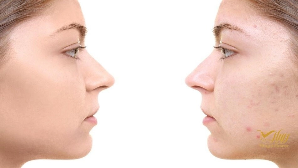 جای جوش دقیقا چه انواعی دارد؟