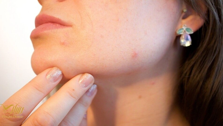 چگونه کرم ضد جوش را درست استفاده کنیم؟